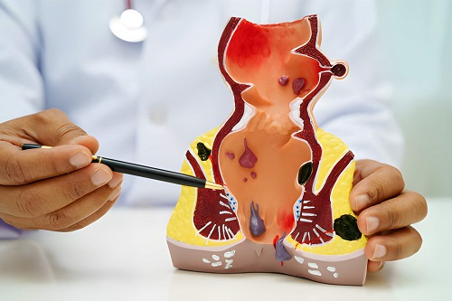 Best Fissure & Fistula Treatment in Andheri